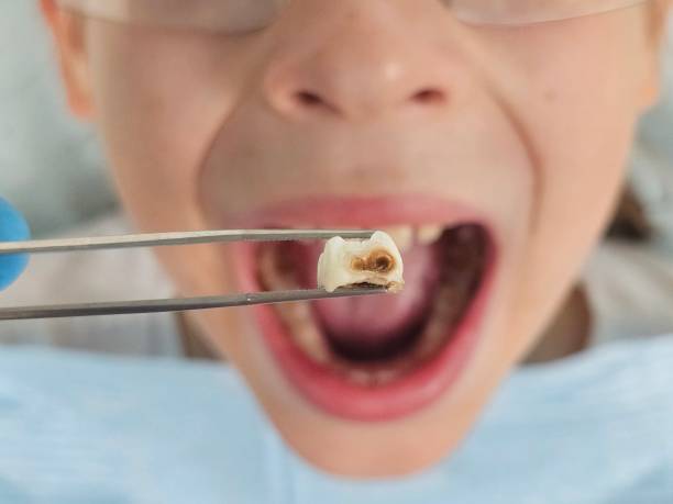 Best Emergency Broken Tooth Repair in Orange Park, FL